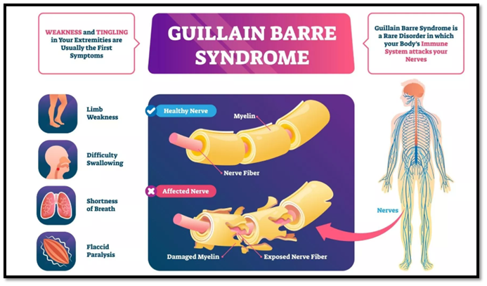 Guillain-Barré Syndrome (GBS)